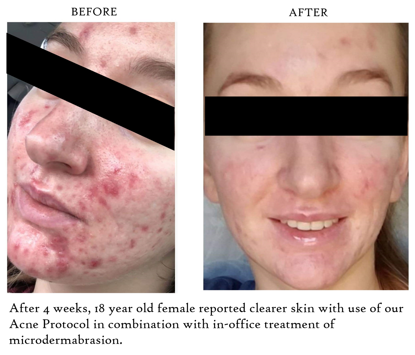 Spot Stop Treatment